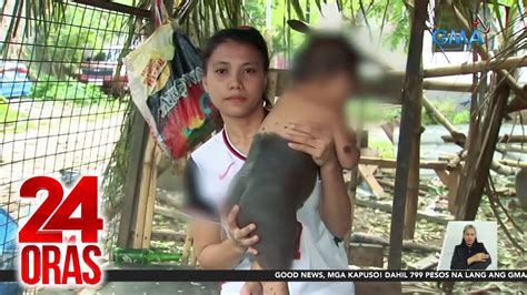24 Oras Part 2: Ipinasuring malaking nunal at balat ng bata; 772 .